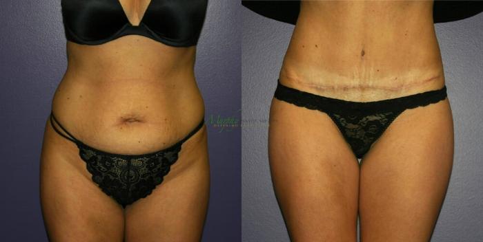 Before & After Abdominoplasty Case 45 Front View in Denver, Colorado