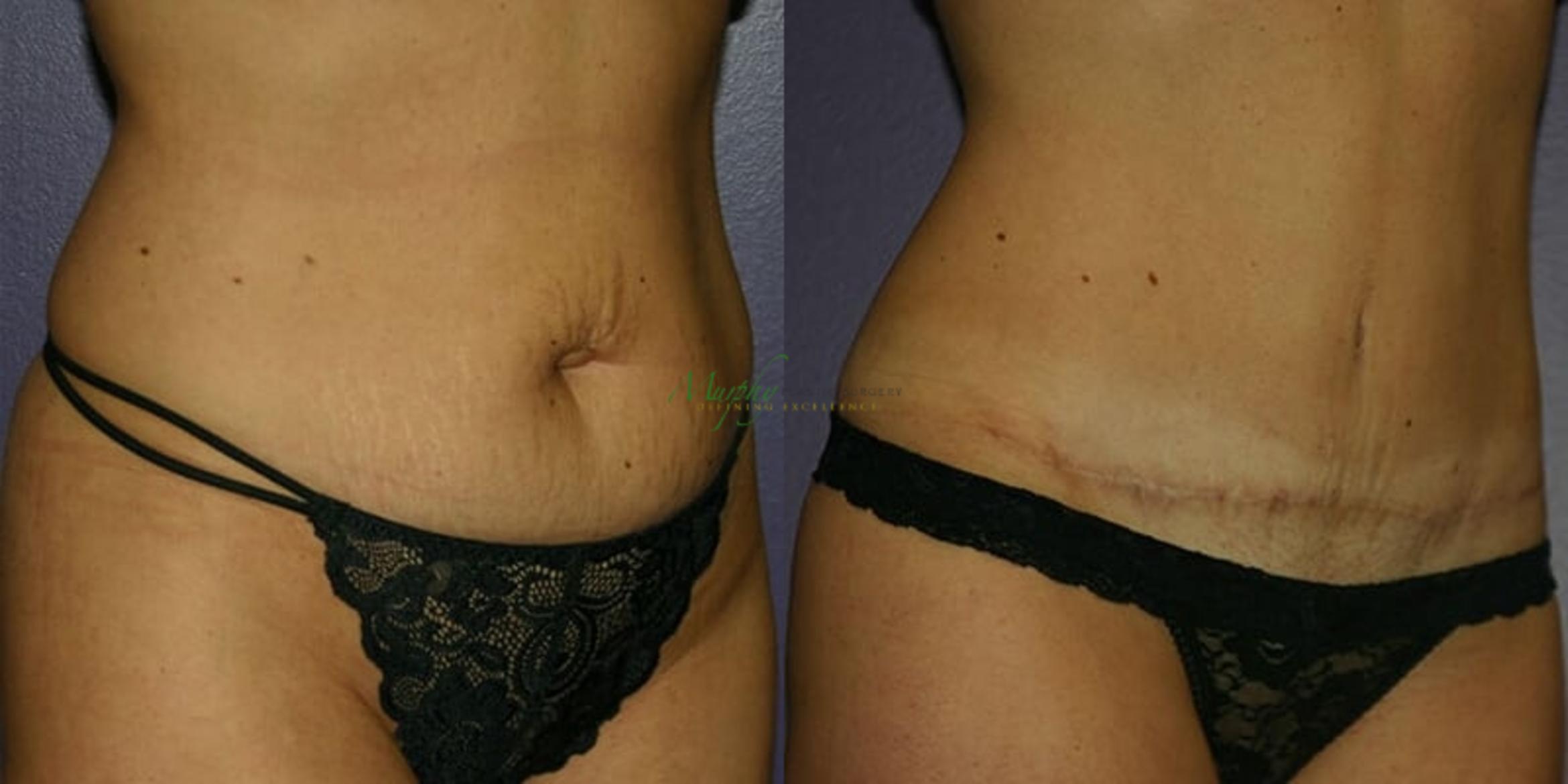 Before & After Abdominoplasty Case 45 Right Oblique View in Denver, Colorado