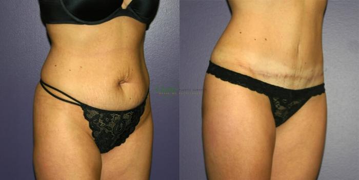 Before & After Abdominoplasty Case 45 Right Oblique Zoomed Out View in Denver, Colorado
