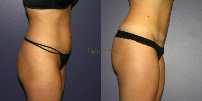 Before & After Abdominoplasty Case 45 Right Side View in Denver, Colorado