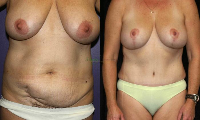 Before & After Abdominoplasty Case 47 Front View in Denver, Colorado