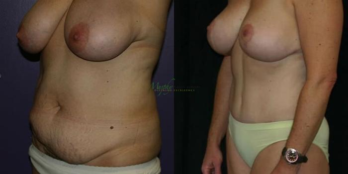 Before & After Abdominoplasty Case 47 Left Oblique View in Denver, Colorado