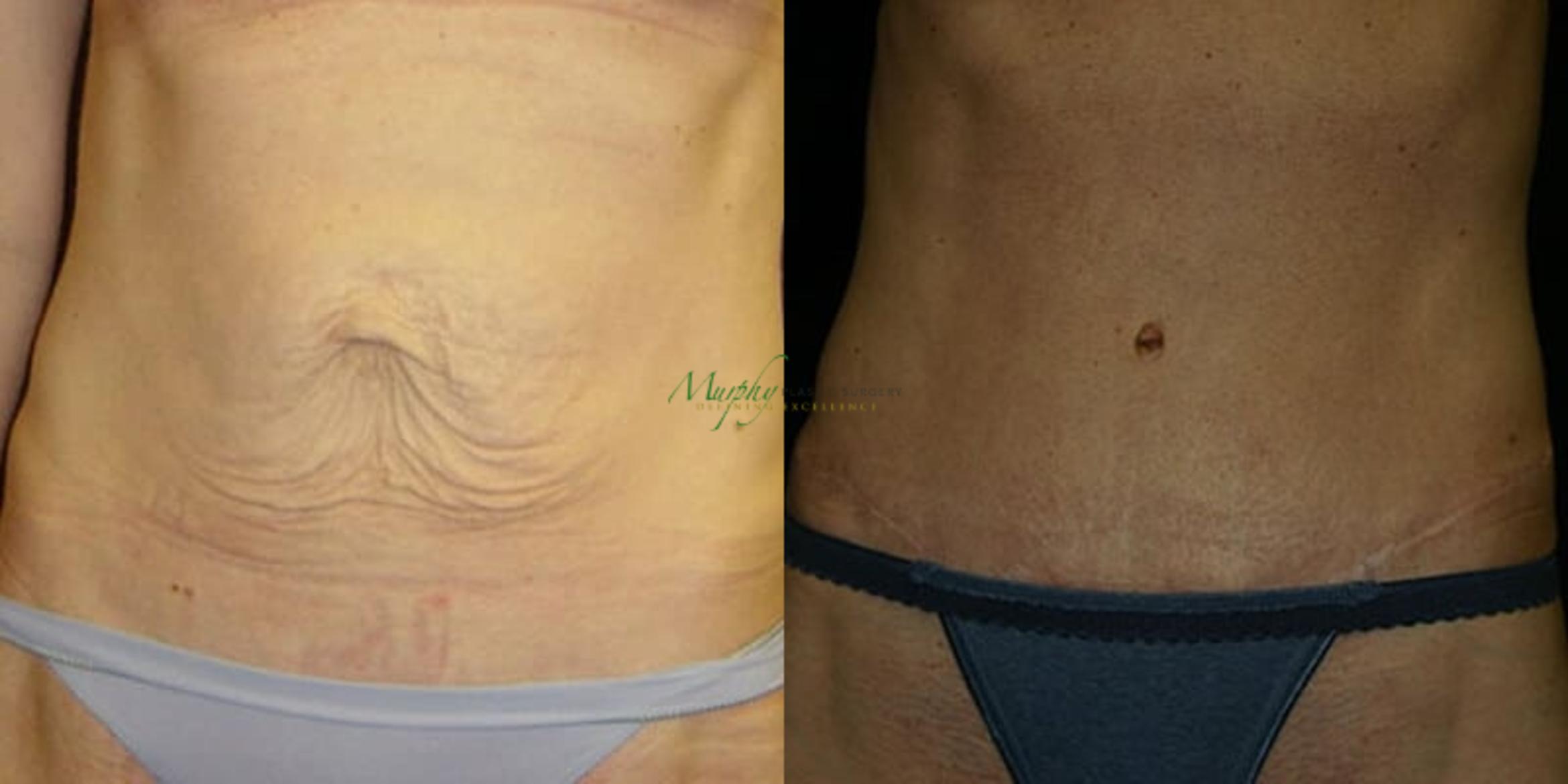 Before & After Abdominoplasty Case 48 Front View in Denver, Colorado