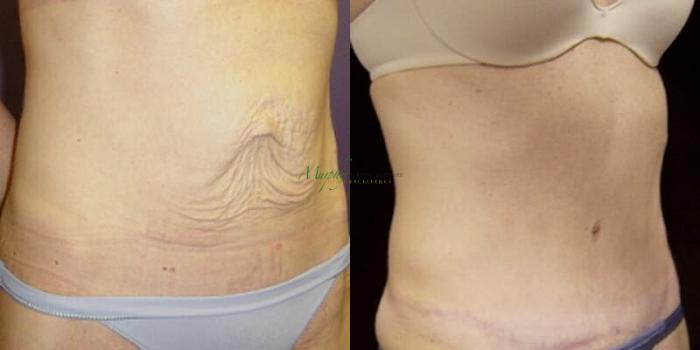Before & After Abdominoplasty Case 48 Right Oblique View in Denver, Colorado