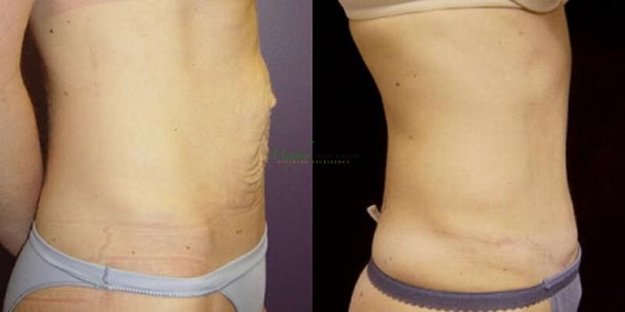 Before & After Abdominoplasty Case 48 Right Side View in Denver, Colorado