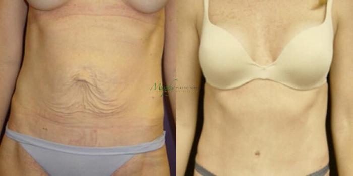 Before & After Abdominoplasty Case 48 Top Front View in Denver, Colorado