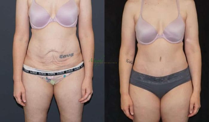 Before & After Abdominoplasty Case 51 Front View in Denver, Colorado