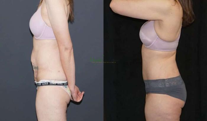 Before & After Abdominoplasty Case 51 Left Side View in Denver, Colorado