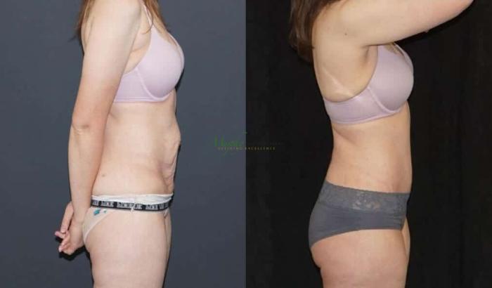 Before & After Abdominoplasty Case 51 Right Side View in Denver, Colorado