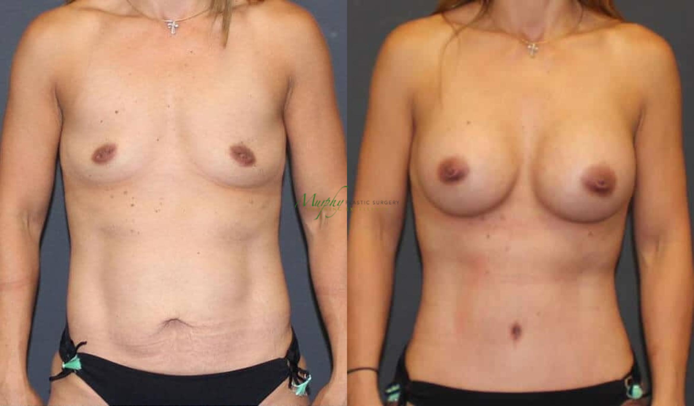 Before & After Abdominoplasty Case 52 Front View in Denver, Colorado