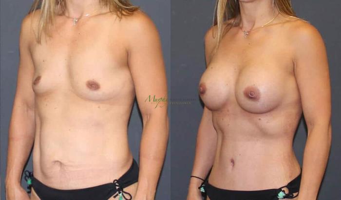 Before & After Abdominoplasty Case 52 Left Oblique View in Denver, Colorado