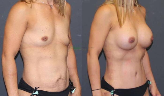 Before & After Abdominoplasty Case 52 Right Oblique View in Denver, Colorado
