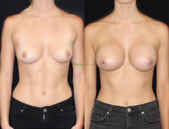 Before & After Breast Augmentation Case 104 Front View in Denver, Colorado