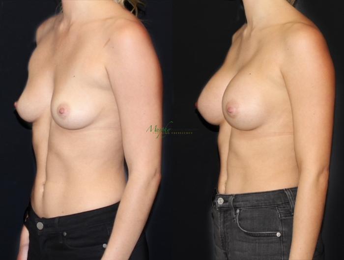 Before & After Breast Augmentation Case 104 Left Side View in Denver, Colorado