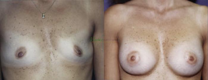 Before & After Breast Augmentation Case 105 Front View in Denver, Colorado