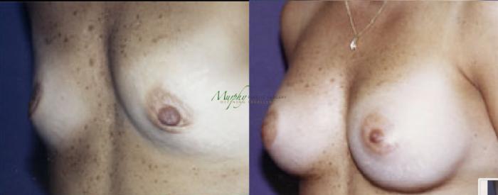 Before & After Breast Augmentation Case 105 Left Side View in Denver, Colorado