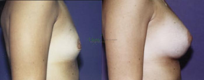 Before & After Breast Augmentation Case 105 Right Side View in Denver, Colorado