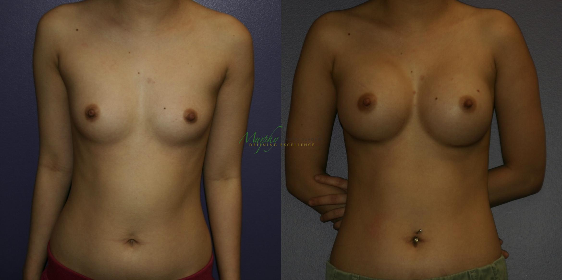Before & After Breast Augmentation Case 106 Front View in Denver, Colorado