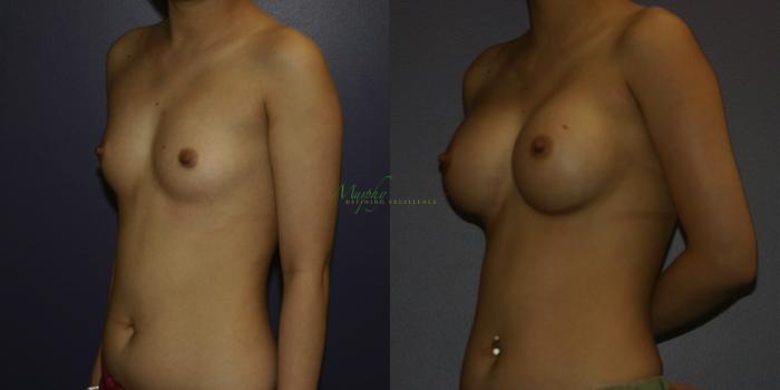 Before & After Breast Augmentation Case 106 Left Oblique View in Denver, Colorado