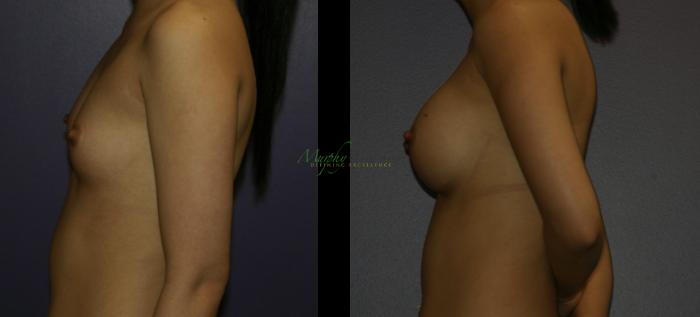 Before & After Breast Augmentation Case 106 Left Side View in Denver, Colorado