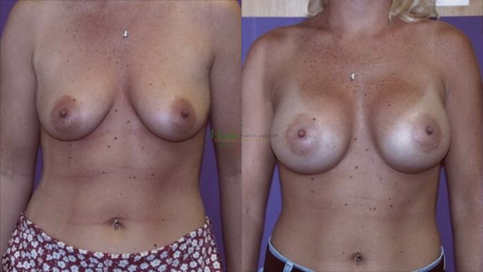 Before & After Breast Augmentation Case 107 Front View in Denver, Colorado