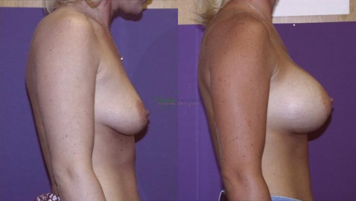 Before & After Breast Augmentation Case 107 Right Side View in Denver, Colorado