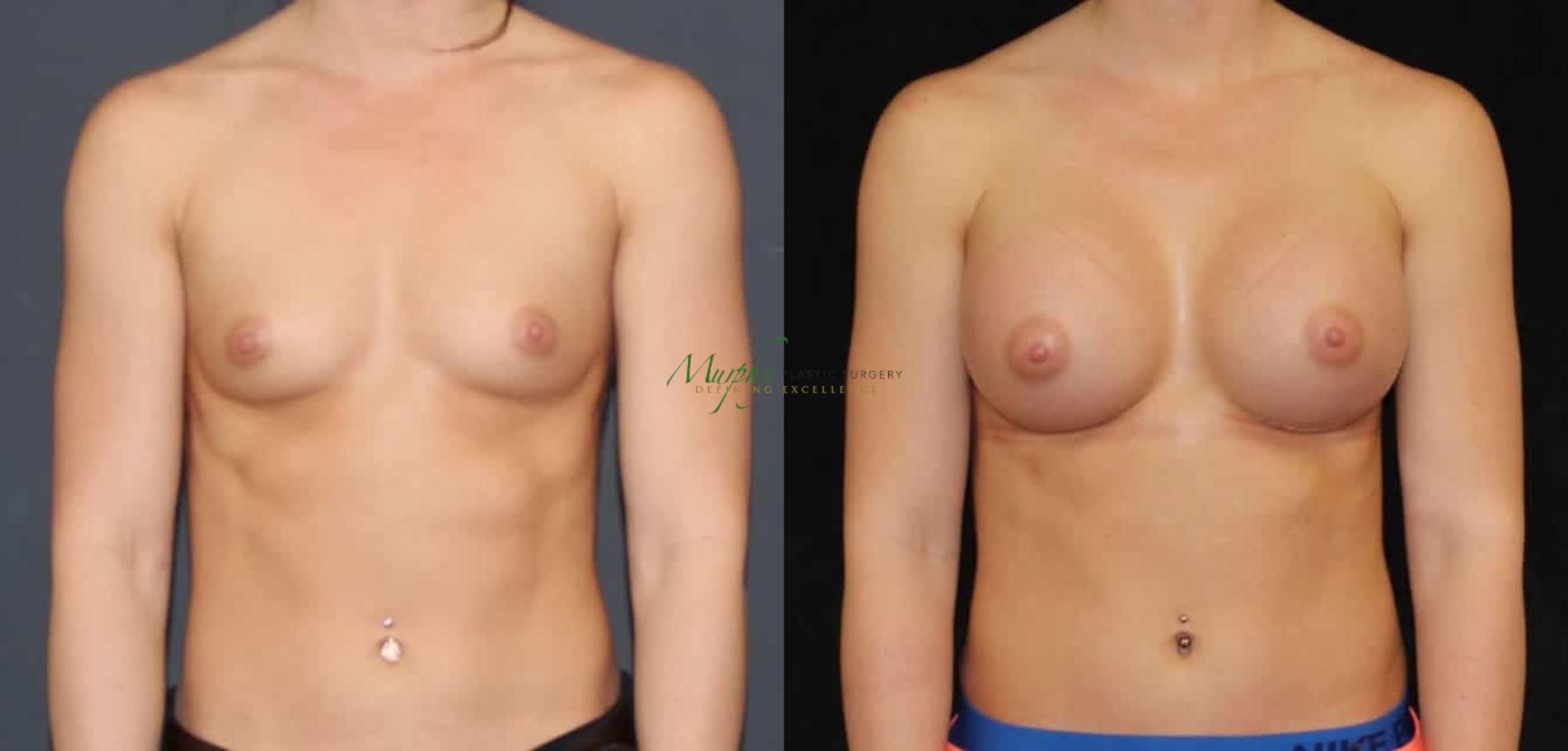 Before & After Breast Augmentation Case 63 Front View in Denver, Colorado