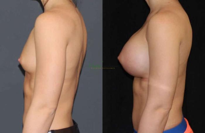 Before & After Breast Augmentation Case 63 Left Side View in Denver, Colorado