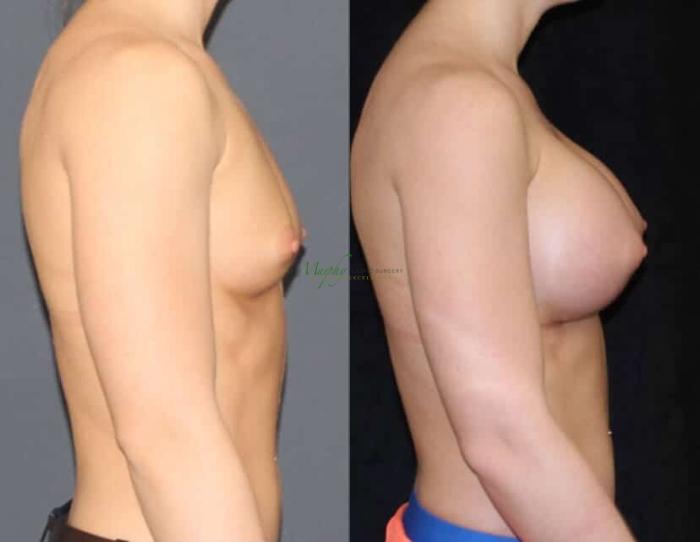 Before & After Breast Augmentation Case 63 Right Side View in Denver, Colorado
