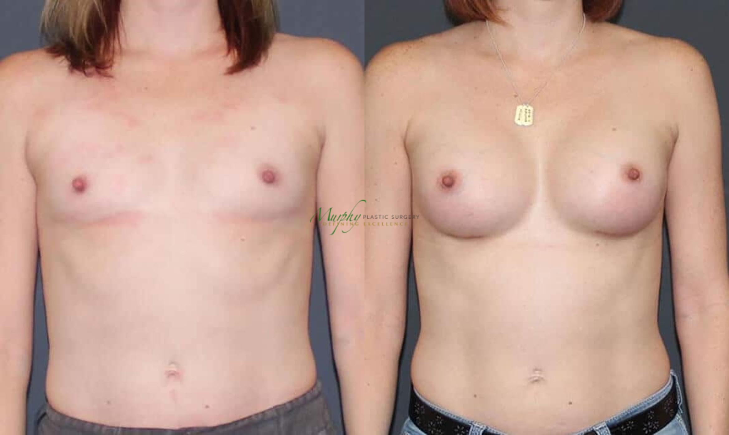 Before & After Breast Augmentation Case 64 Front View in Denver, Colorado