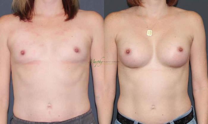 Before & After Breast Augmentation Case 64 Front View in Denver, Colorado