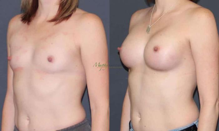 Before & After Breast Augmentation Case 64 Left Oblique View in Denver, Colorado