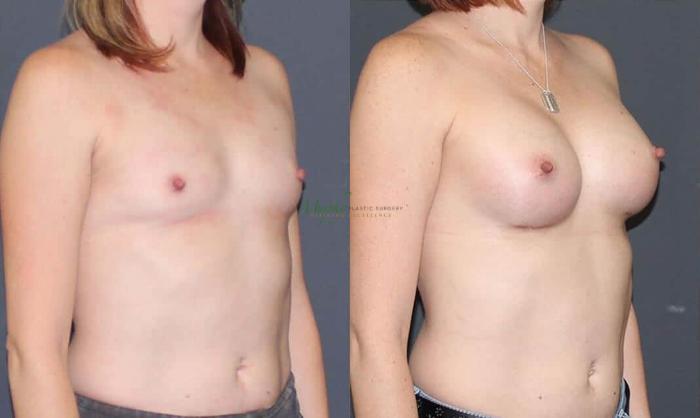 Before & After Breast Augmentation Case 64 Right Oblique View in Denver, Colorado