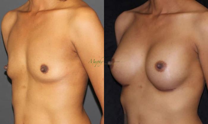 Before & After Breast Augmentation Case 67 Left Oblique View in Denver, Colorado