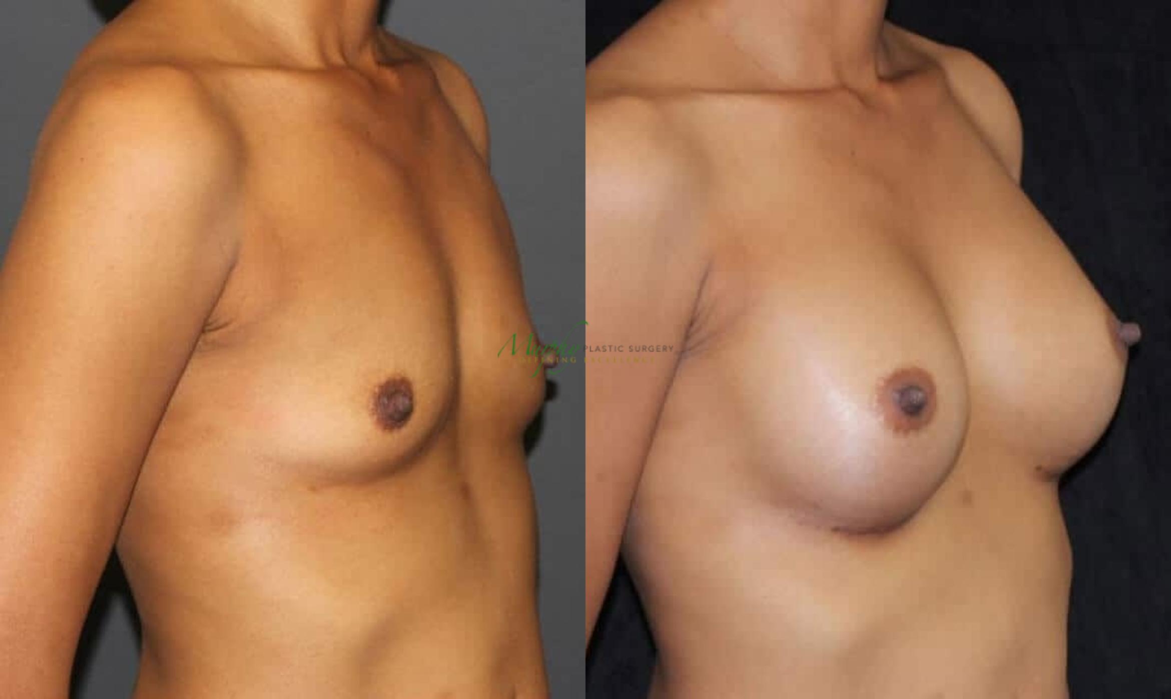 Before & After Breast Augmentation Case 67 Right Oblique View in Denver, Colorado