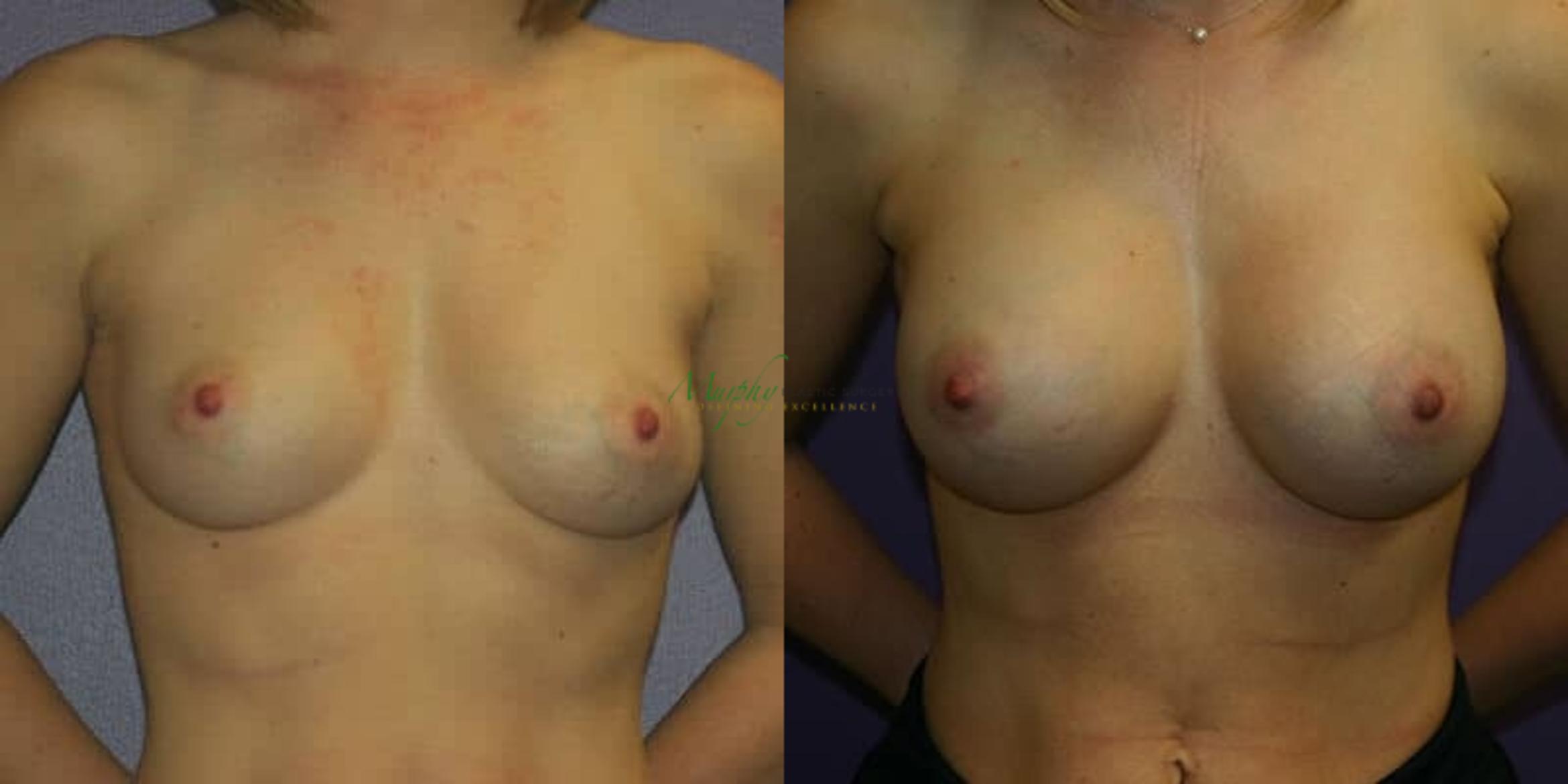 Before & After Breast Augmentation Case 84 Front View in Denver, Colorado