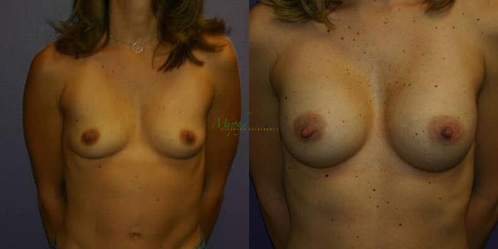 Before & After Breast Augmentation Case 85 Front View in Denver, Colorado