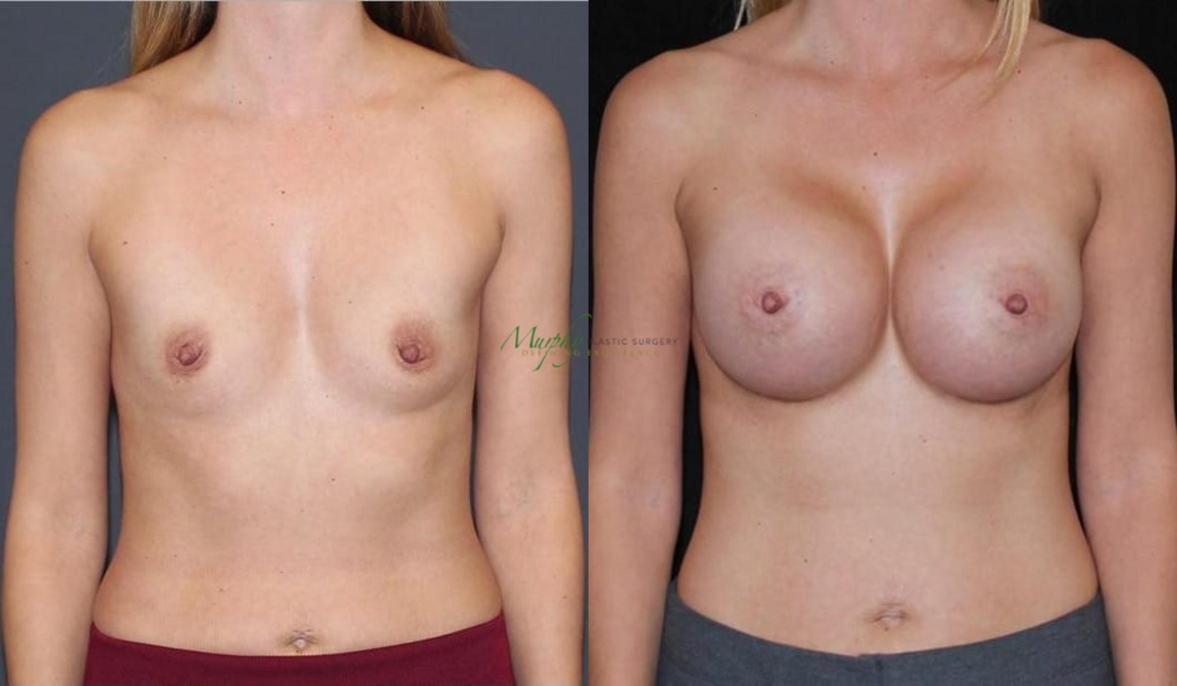 Before & After Breast Augmentation Case 87 Front View in Denver, Colorado