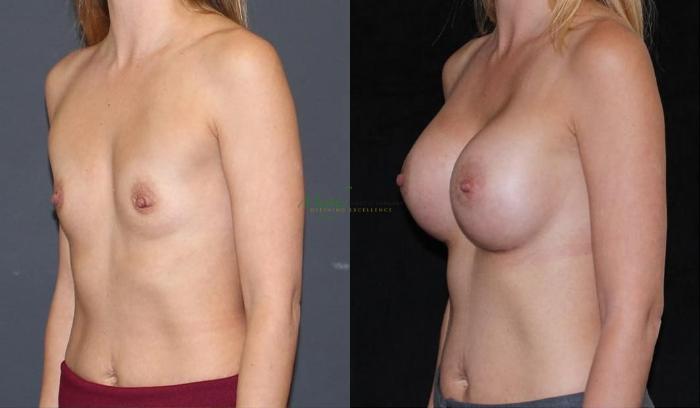 Before & After Breast Augmentation Case 87 Left Oblique View in Denver, Colorado
