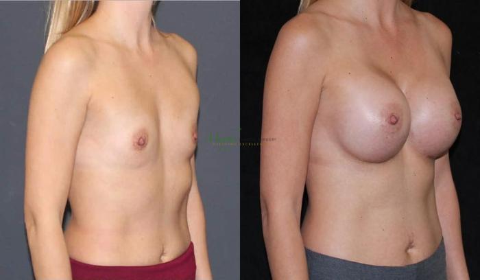Before & After Breast Augmentation Case 87 Right Oblique View in Denver, Colorado