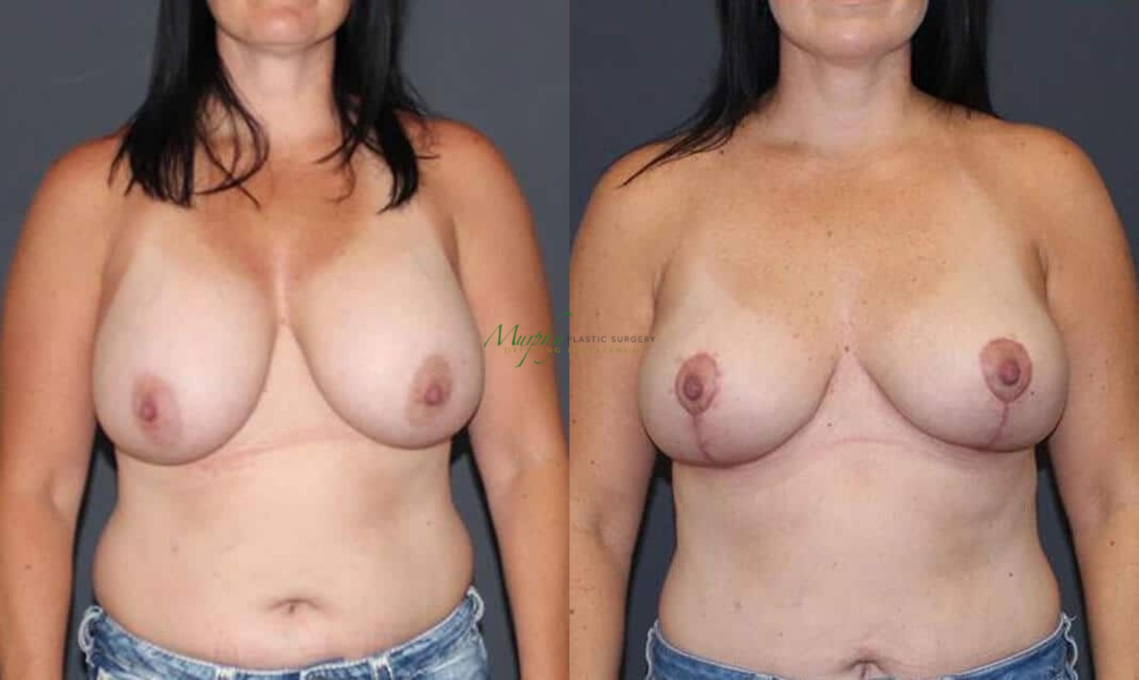 Before & After Breast Lift Case 102 Front View in Denver, Colorado