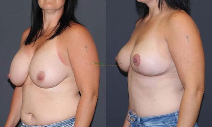 Before & After Breast Lift Case 102 Left Oblique View in Denver, Colorado