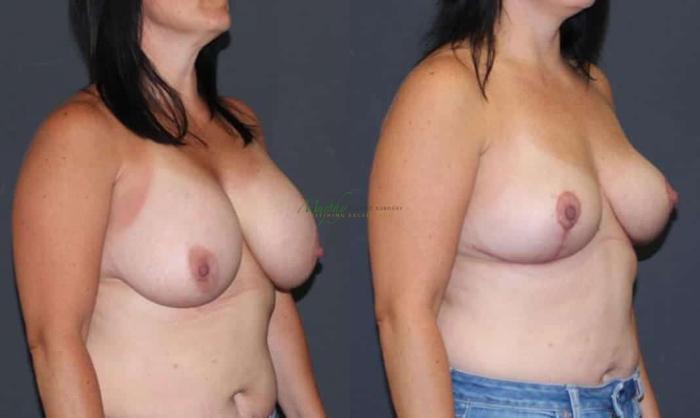 Before & After Breast Lift Case 102 Right Oblique View in Denver, Colorado