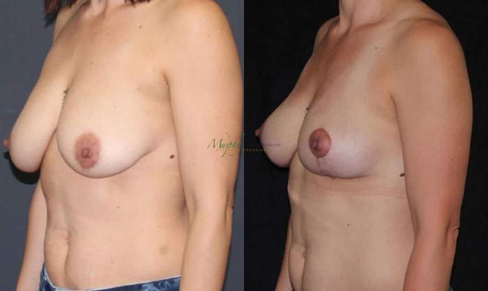 Before & After Breast Lift Case 96 Left Oblique View in Denver, Colorado