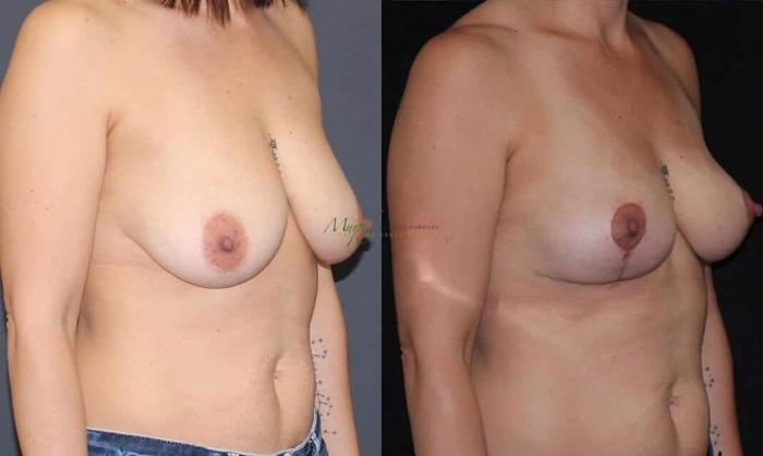 Before & After Breast Lift Case 96 Right Oblique View in Denver, Colorado