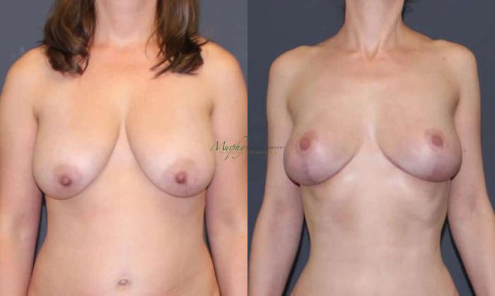 Before & After Breast Lift Case 98 Front View in Denver, Colorado