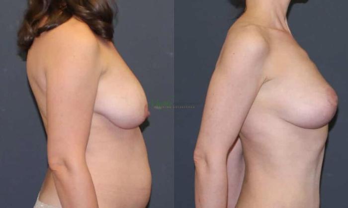 Before & After Breast Lift Case 98 Right Side View in Denver, Colorado