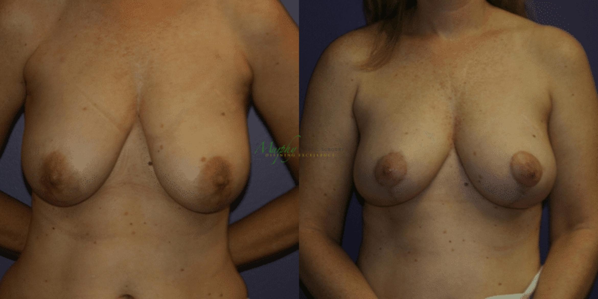 Before & After Breast Reduction Case 88 Front View in Denver, Colorado