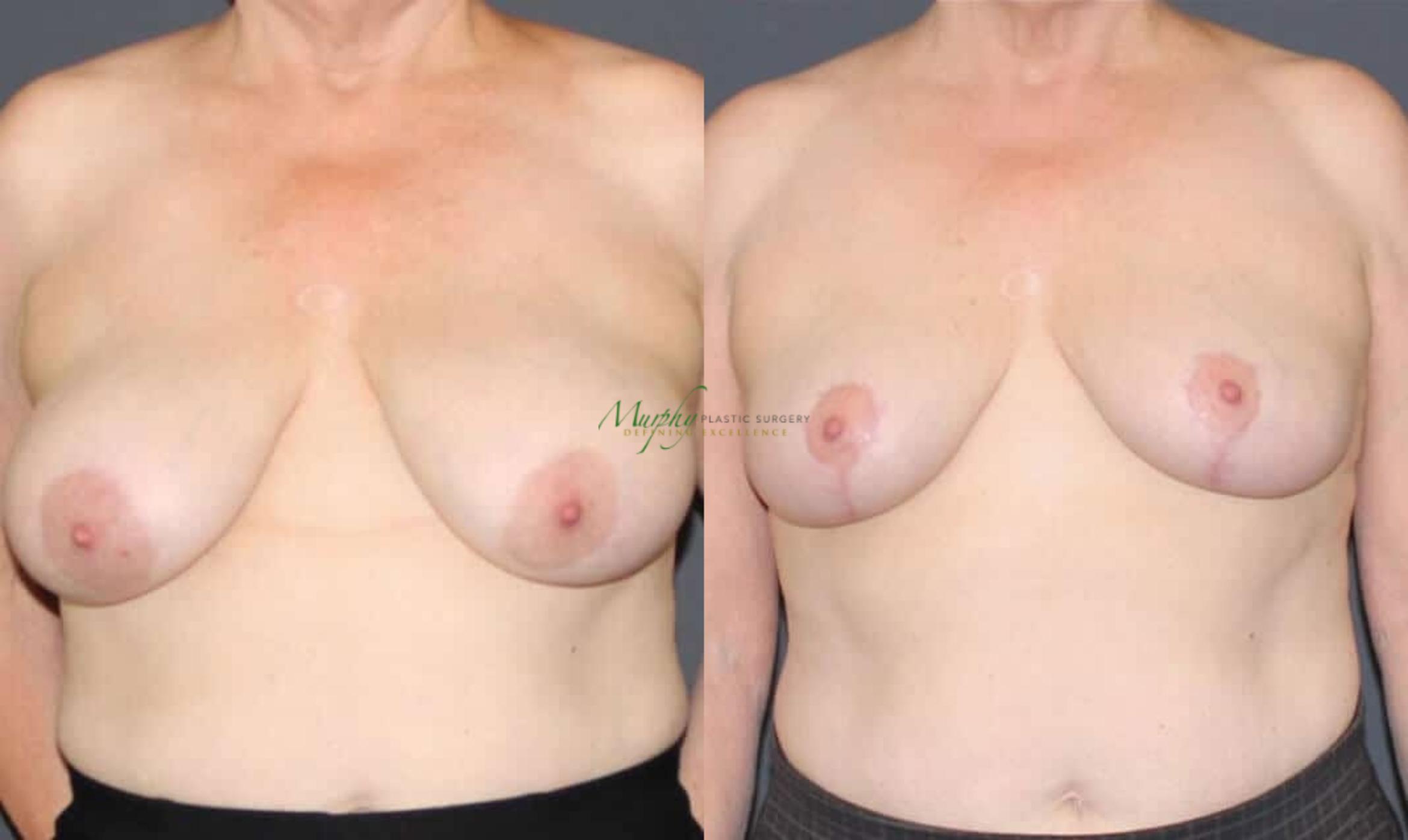 Before & After Breast Reduction Case 89 Front View in Denver, Colorado