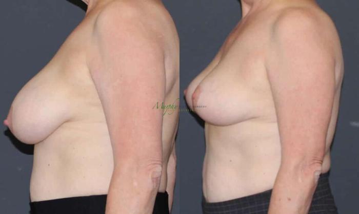 Before & After Breast Reduction Case 89 Left Side View in Denver, Colorado